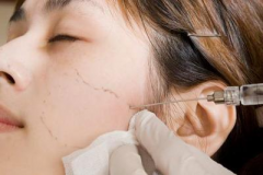 臉部三厘米長的凹陷疤痕,可以打玻尿酸填平嗎